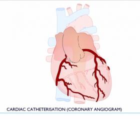 Cardiac Catheter