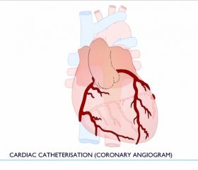 Cardiac Catheter Cardiac Catheter