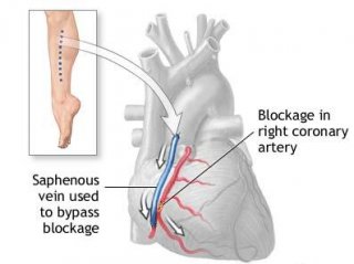 Coronary artery bypass graft Coronary artery bypass graft