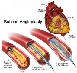 Coronary angioplasty