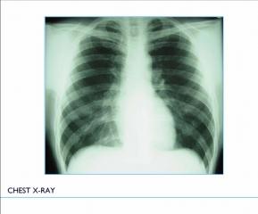 Chest X-Ray